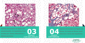 Aspecto microscópico de um fígado com esteatohepatite e com fibrose.