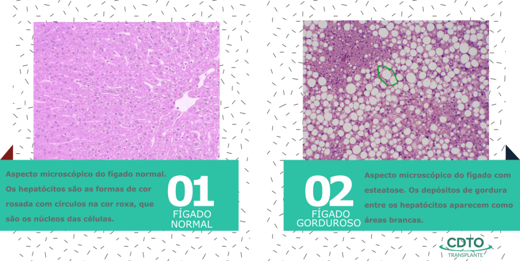 Aspecto microscópico de um fígado normal e com esteatose.